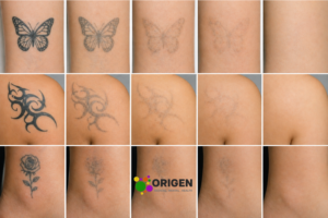 Laser Tattoo Removal 
