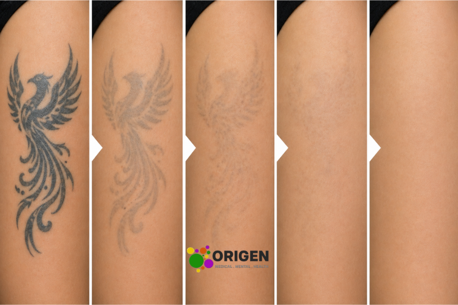Laser Tattoo Removal Before and After