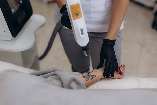 laser tattoo removal Omaha