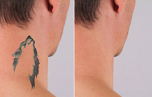 Laser tattoo removal before and After