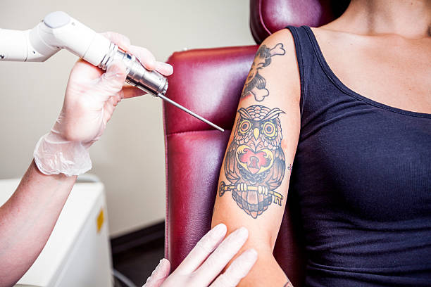 laser tattoo removal in Omaha