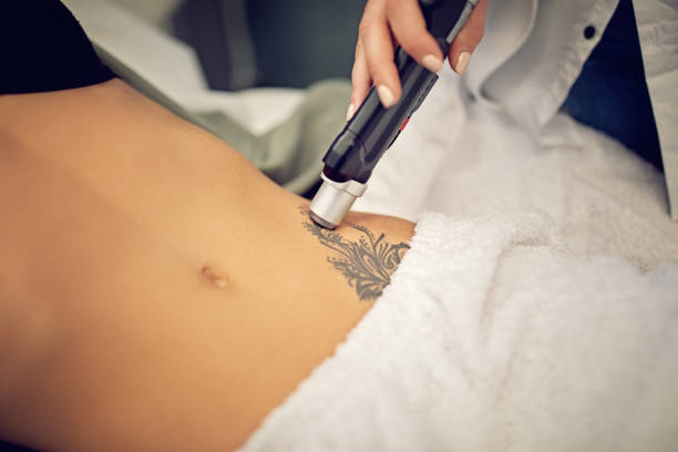 Best laser tattoo removal