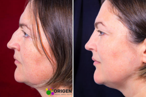 Morpheus8 Before and After